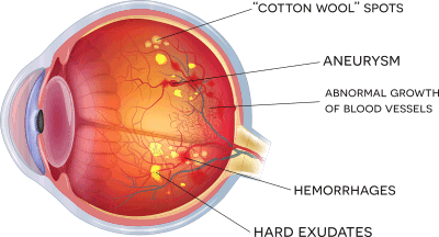 diabetic-eye
